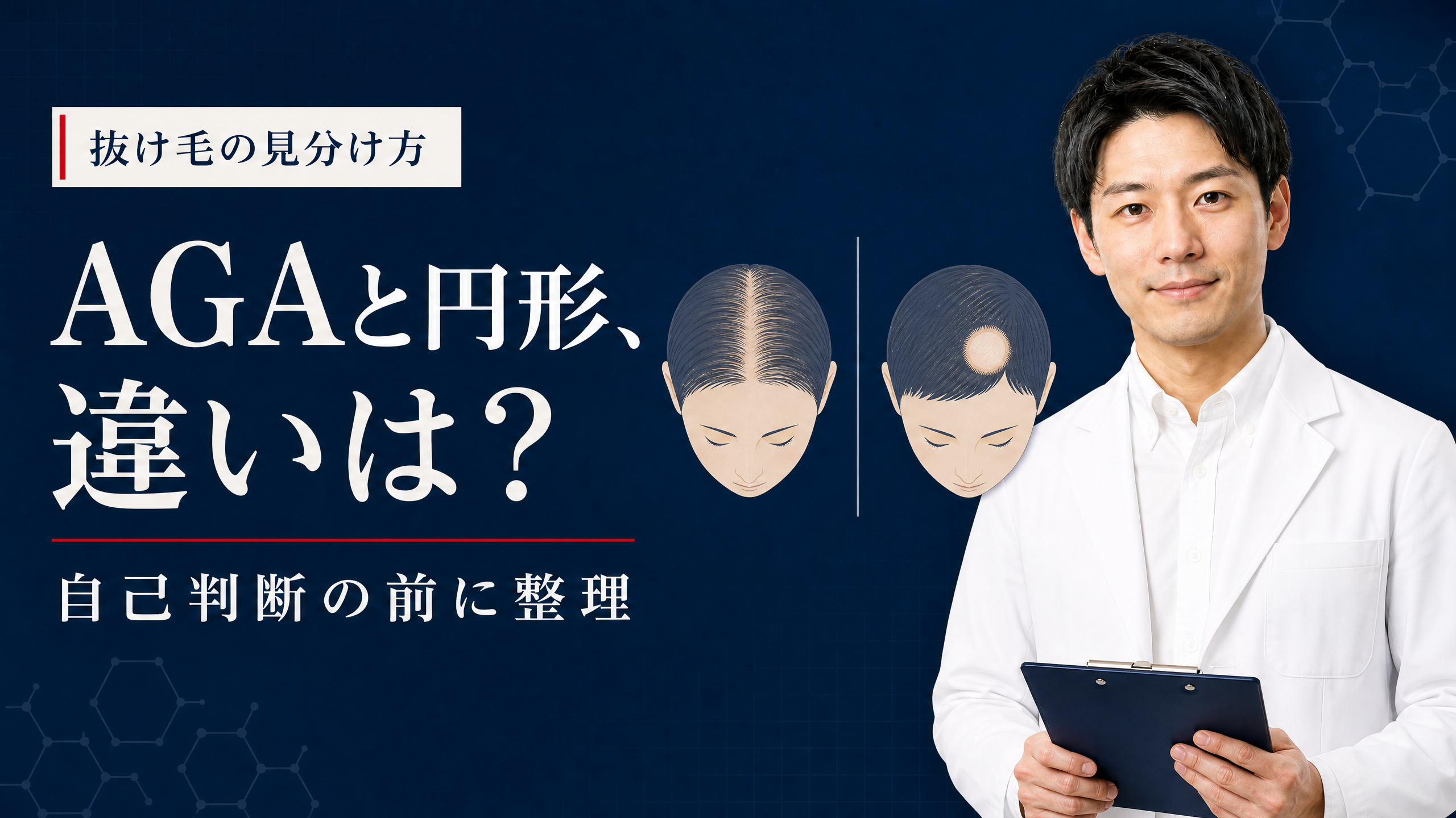 AGAと円形脱毛症の違いを見分けるポイントを示すアイキャッチ